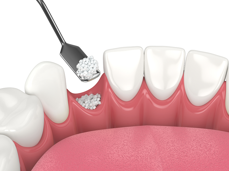 Bone Grafting: A Vital Step Toward Restoring Oral Health